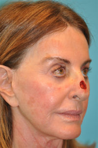 Skin Cancer Reconstruction