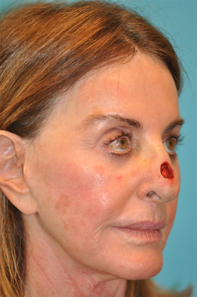 Skin Cancer Reconstruction Before and After Photos Case 5616 Before Photo Skin Cancer Reconstruction Before and After Photos