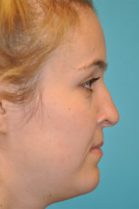 Rhinoplasty (Nose Job) Before and After Photos