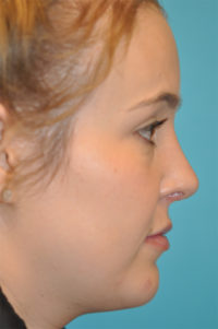 Rhinoplasty (Nose Job) Before and After Photos