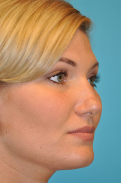 Rhinoplasty (Nose Job) Before and After Photos