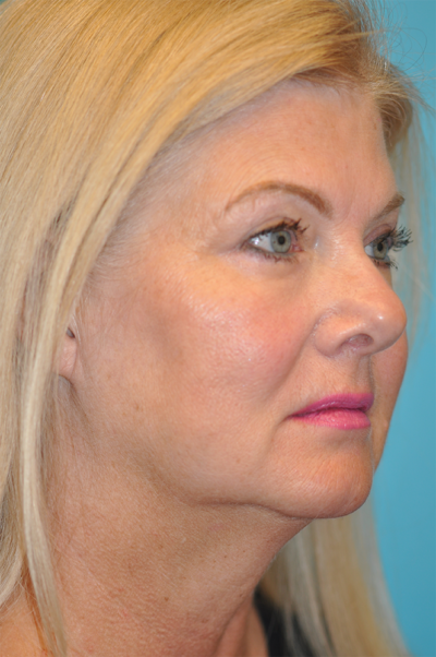 Upper Blepharoplasty (Eyelid) Before and After Photos