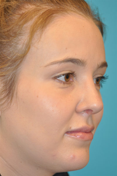 Rhinoplasty (Nose Job) Before and After Photos Case 5657 After Photo Rhinoplasty (Nose Job) Before and After Photos