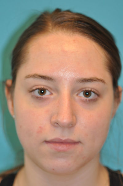 Rhinoplasty (Nose Job) Before and After Photos Case 5668 Before Photo Rhinoplasty (Nose Job) Before and After Photos