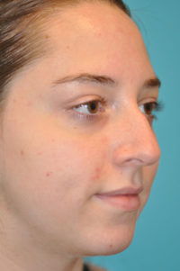 Rhinoplasty (Nose Job) Before and After Photos