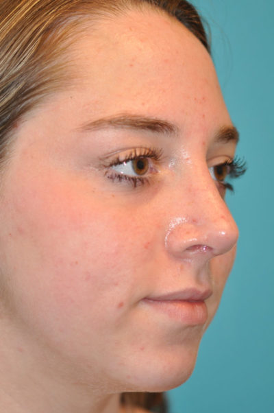 Rhinoplasty (Nose Job) Before and After Photos Case 5668 After Photo Rhinoplasty (Nose Job) Before and After Photos