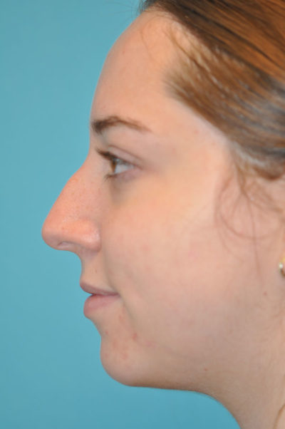 Rhinoplasty (Nose Job) Before and After Photos Case 5668 Before Photo Rhinoplasty (Nose Job) Before and After Photos