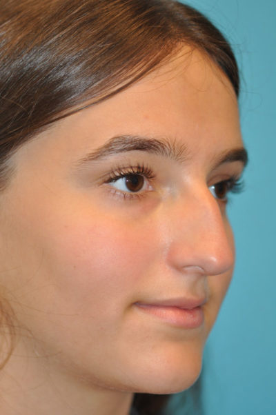 Rhinoplasty (Nose Job) Before and After Photos Case 5669 Before Photo Rhinoplasty (Nose Job) Before and After Photos
