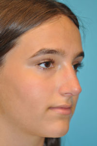 Rhinoplasty (Nose Job) Before and After Photos