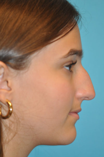 Rhinoplasty (Nose Job) Before and After Photos Case 5669 Before Photo Rhinoplasty (Nose Job) Before and After Photos
