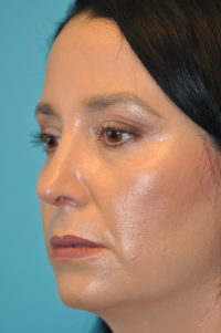 Rhinoplasty (Nose Job) Before and After Photos