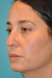 Rhinoplasty (Nose Job) Before and After Photos