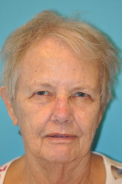 Skin Cancer Reconstruction Before and After Photos Case 9856 Before Photo Skin Cancer Reconstruction Before and After Photos
