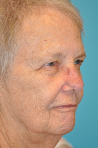 Skin Cancer Reconstruction Before and After Photos Case 9856 After Photo Skin Cancer Reconstruction Before and After Photos