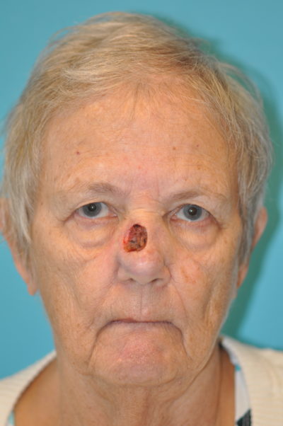 Skin Cancer Reconstruction Before and After Photos Case 9856 Before Photo Skin Cancer Reconstruction Before and After Photos