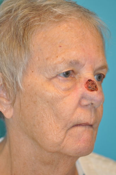 Skin Cancer Reconstruction Before and After Photos Case 9856 After Photo Skin Cancer Reconstruction Before and After Photos