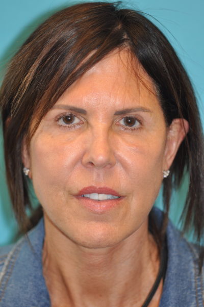 Facelift and Necklift Before and After Photos Case 5985 After Photo Facelift and Necklift Before and After Photos