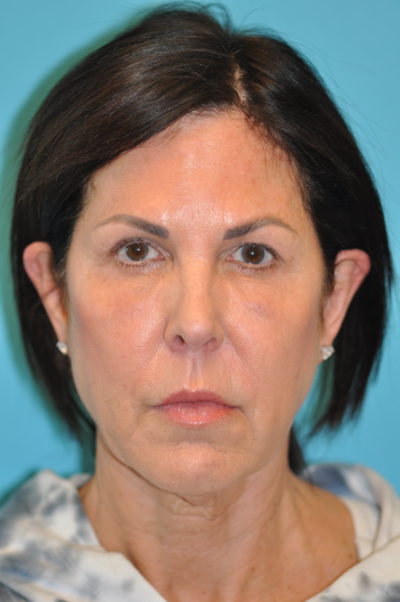 Facelift and Necklift Before and After Photos Case 5985 Before Photo Facelift and Necklift Before and After Photos