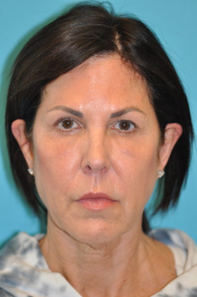 Rhytidectomy (Facelift) Before and After Photos