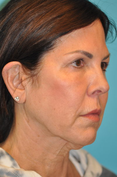 Facelift and Necklift Before and After Photos Case 5985 Before Photo Facelift and Necklift Before and After Photos