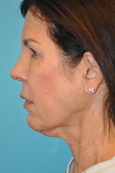 Facelift and Necklift Before and After Photos Case 5985 Before Photo Facelift and Necklift Before and After Photos