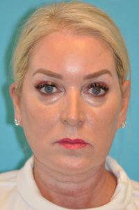 Facelift and Necklift Before and After Photos