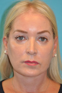 Facelift and Necklift Before and After Photos
