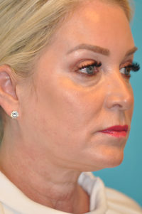 Facelift and Necklift Before and After Photos