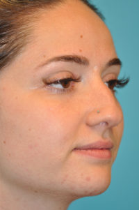 Rhinoplasty (Nose Job) Before and After Photos