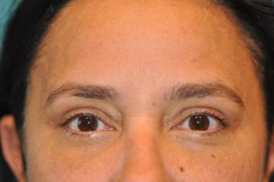 Upper Blepharoplasty (Eyelid) Before and After Photos