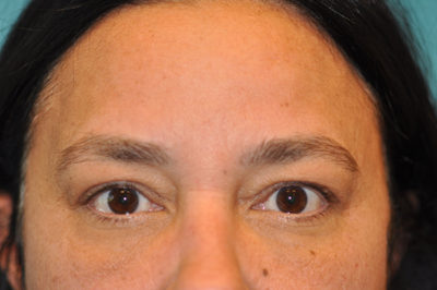 Upper Blepharoplasty (Eyelid) Before and After Photos Case 5838 After Photo Upper Blepharoplasty (Eyelid) Before and After Photos