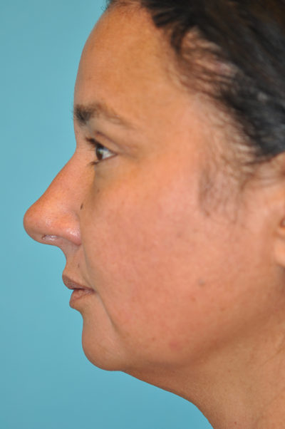 Upper Blepharoplasty (Eyelid) Before and After Photos Case 5838 After Photo Upper Blepharoplasty (Eyelid) Before and After Photos