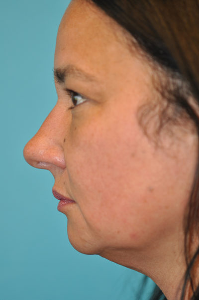 Upper Blepharoplasty (Eyelid) Before and After Photos Case 5838 Before Photo Upper Blepharoplasty (Eyelid) Before and After Photos