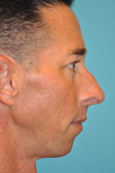 Rhinoplasty (Nose Job) Before and After Photos Case 5845 Before Photo Rhinoplasty (Nose Job) Before and After Photos