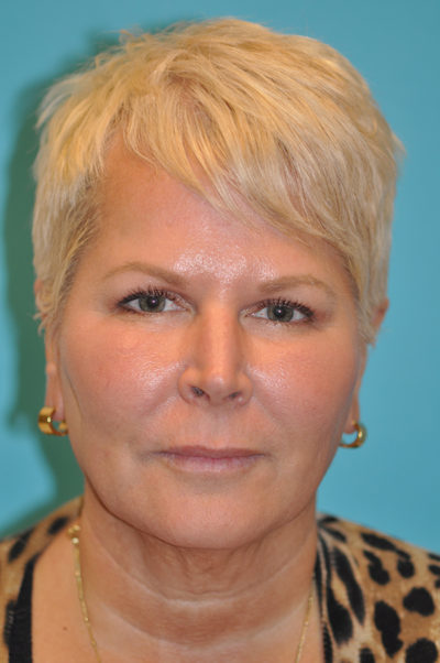 Facelift and Necklift Before and After Photos Case 5861 Before Photo Facelift and Necklift Before and After Photos