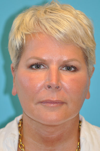 Facelift and Necklift Before and After Photos Case 5861 After Photo Facelift and Necklift Before and After Photos