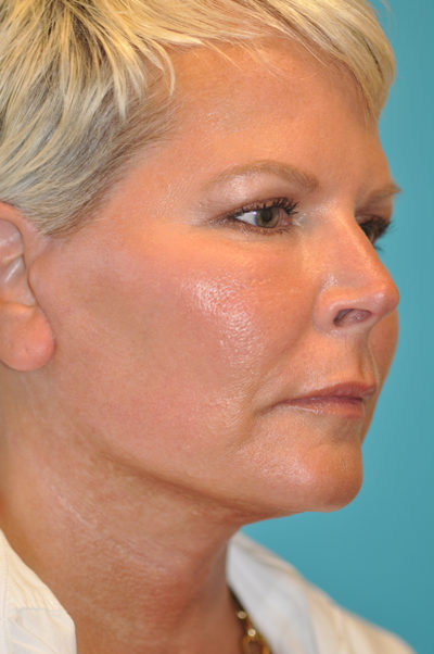 Facelift and Necklift Before and After Photos Case 5861 After Photo Facelift and Necklift Before and After Photos
