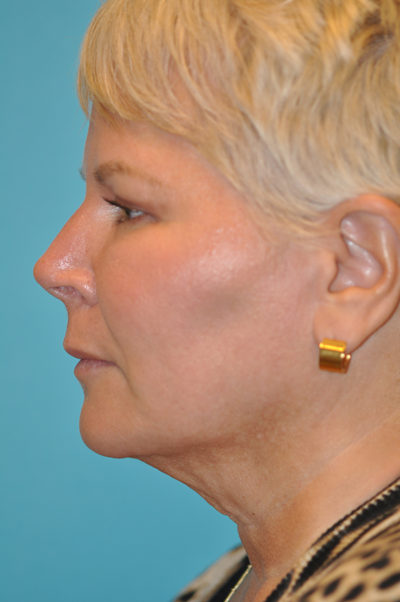 Facelift and Necklift Before and After Photos Case 5861 Before Photo Facelift and Necklift Before and After Photos