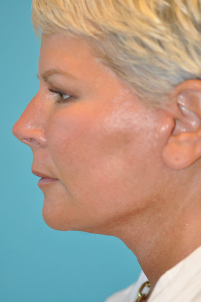 Facelift and Necklift Before and After Photos Case 5861 After Photo Facelift and Necklift Before and After Photos
