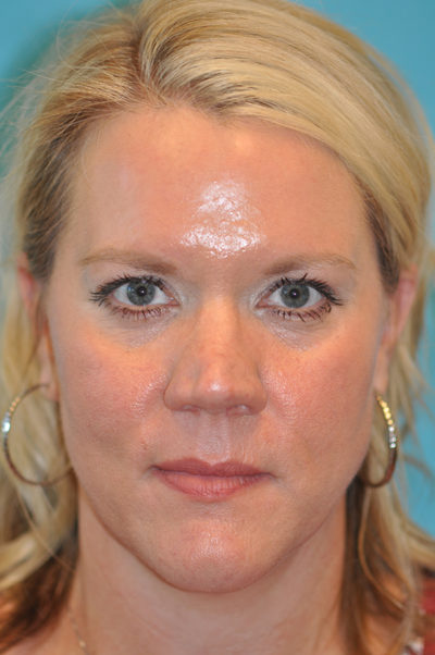 Rhinoplasty (Nose Job) Before and After Photos Case 5868 Before Photo Rhinoplasty (Nose Job) Before and After Photos