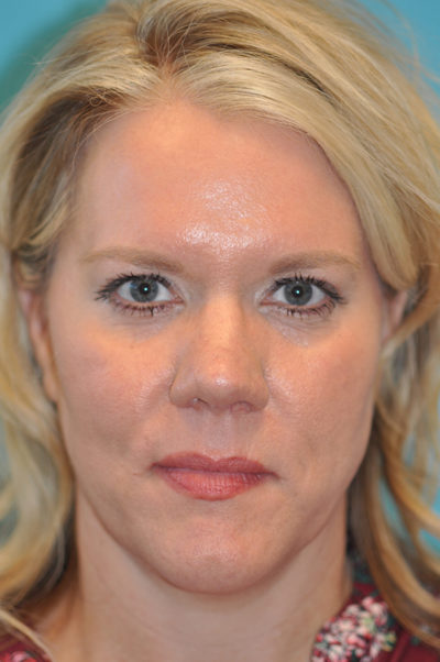 Rhinoplasty (Nose Job) Before and After Photos Case 5868 After Photo Rhinoplasty (Nose Job) Before and After Photos
