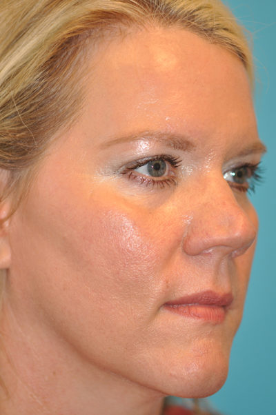 Rhinoplasty (Nose Job) Before and After Photos Case 5868 Before Photo Rhinoplasty (Nose Job) Before and After Photos