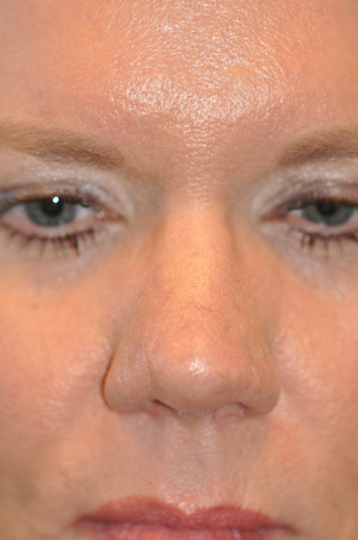 Rhinoplasty (Nose Job) Before and After Photos Case 5868 After Photo Rhinoplasty (Nose Job) Before and After Photos