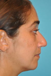 Rhinoplasty (Nose Job) Before and After Photos