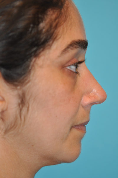 Rhinoplasty (Nose Job) Before and After Photos Case 5875 After Photo Rhinoplasty (Nose Job) Before and After Photos