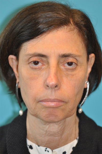 Facelift and Necklift Before and After Photos