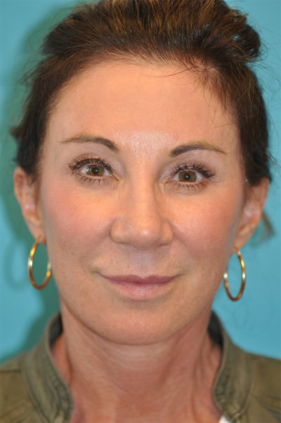Facelift and Necklift Before and After Photos Case 5892 After Photo Facelift and Necklift Before and After Photos