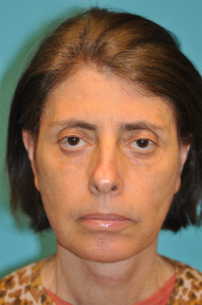 Rhytidectomy (Facelift) Before and After Photos