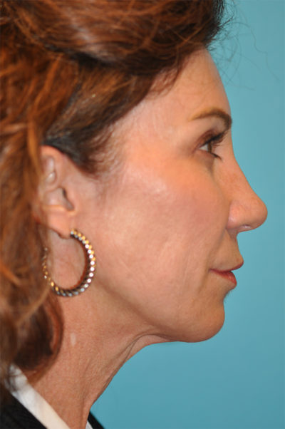 Facelift and Necklift Before and After Photos Case 5892 Before Photo Facelift and Necklift Before and After Photos