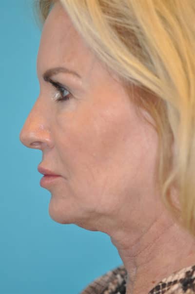 Facelift and Necklift Before and After Photos